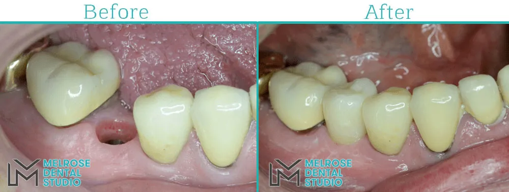 Before and after of a smile restored with Nobel Biocare dental implants, case 3